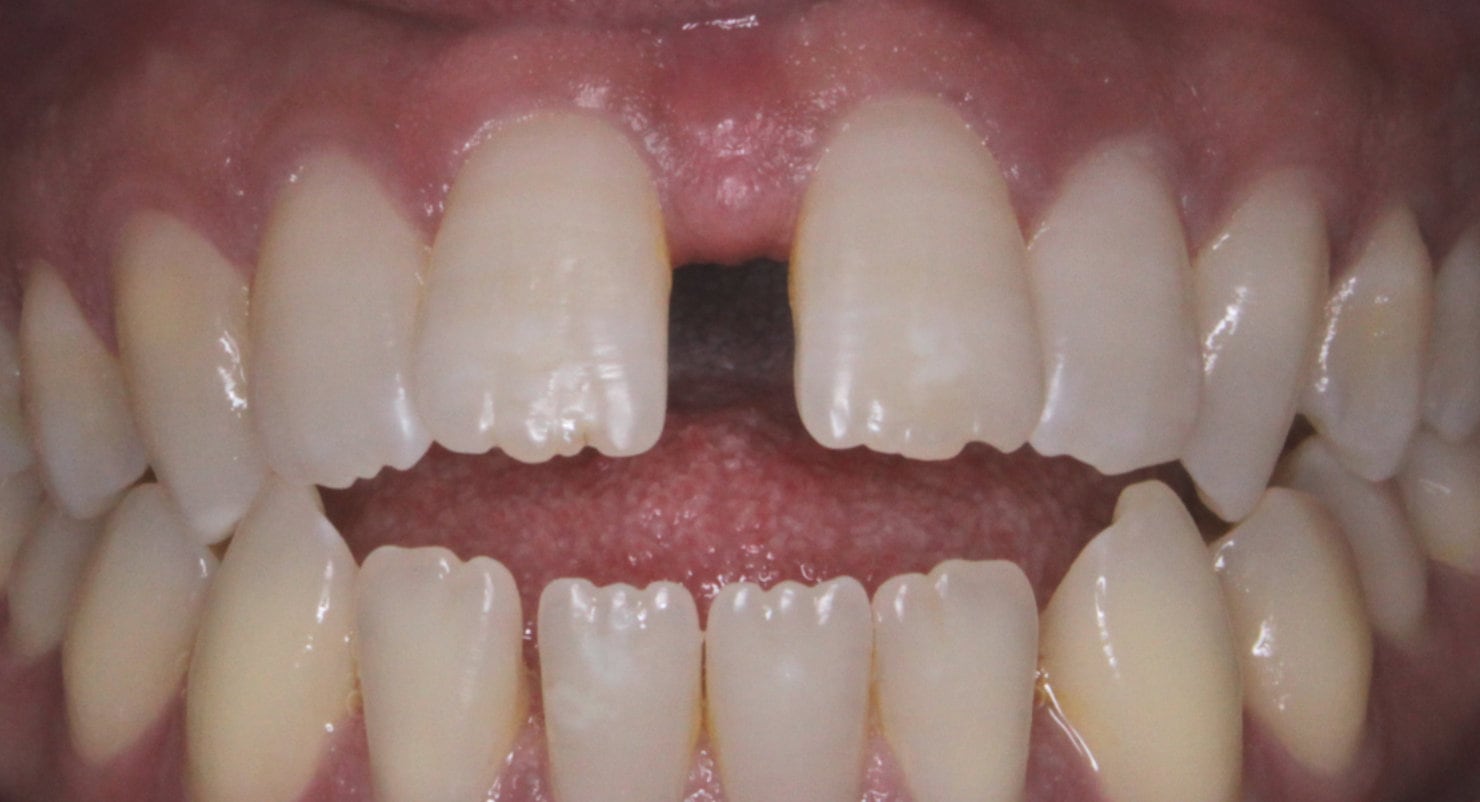 Before & Afters Oklahoma City Braces Edmond Invisalign