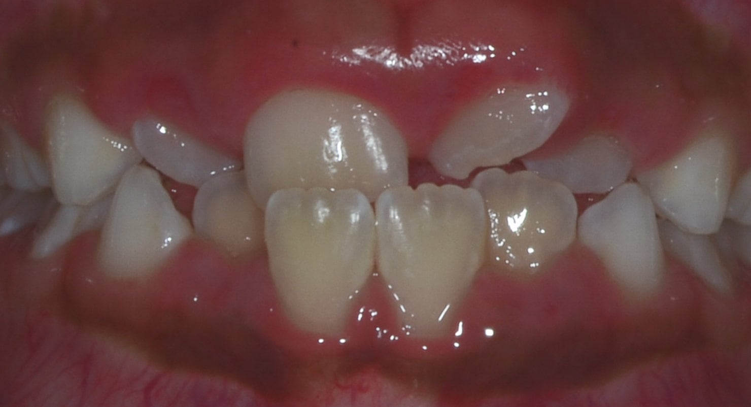 Before & Afters Oklahoma City Braces Edmond Invisalign