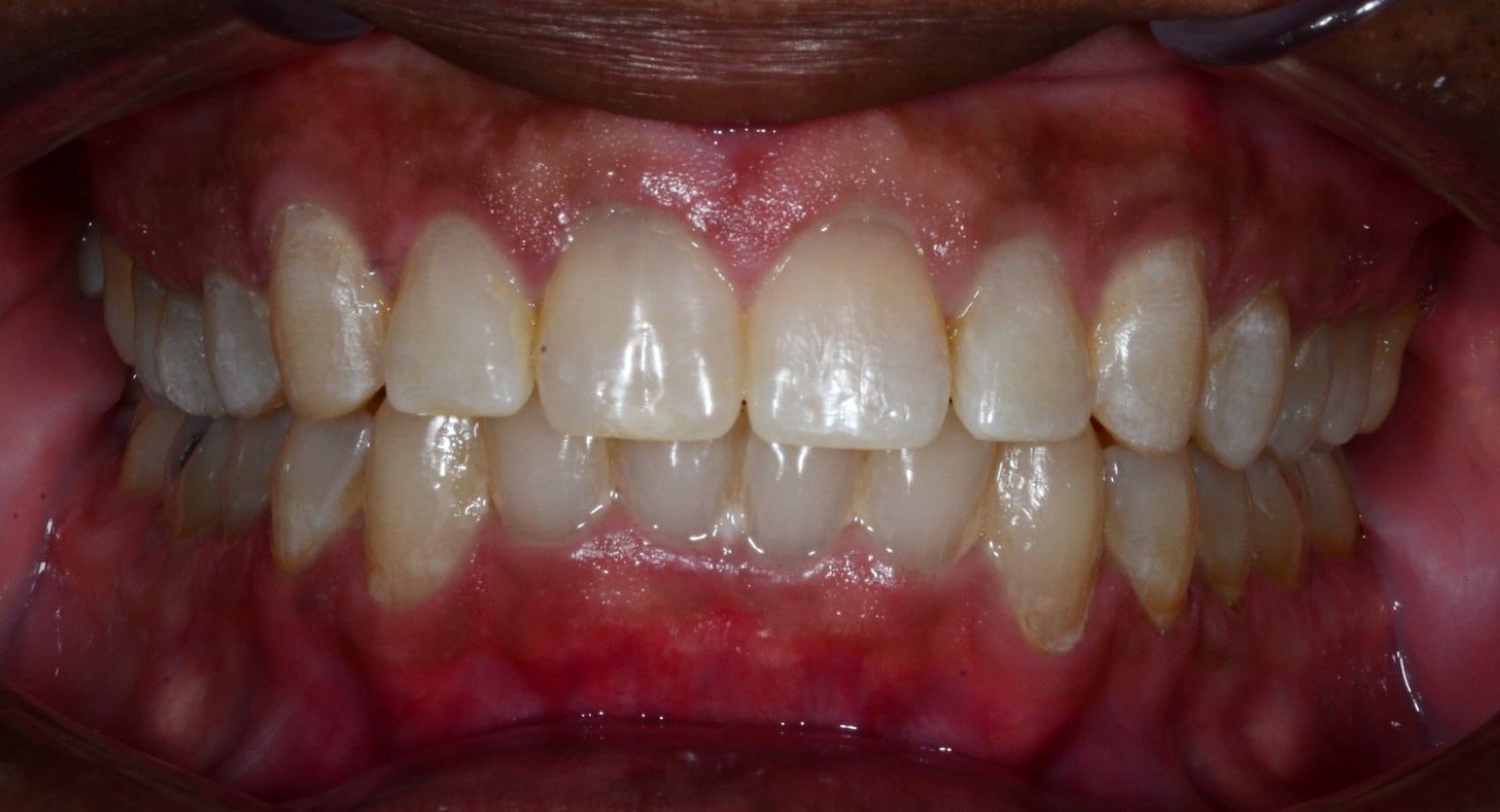 Before & Afters Oklahoma City Braces Edmond Invisalign